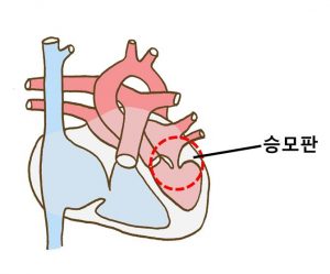 이첨판 폐쇄부전증